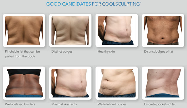 Candidates for CoolSculpting