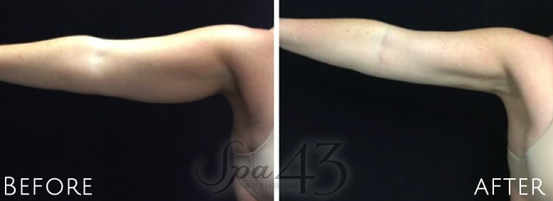 Coolsculpting arm before and after