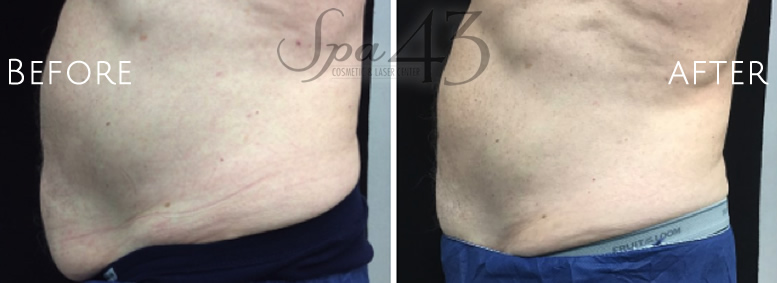 Coolsculpting male stomach