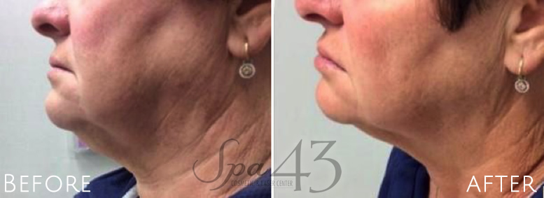Kybella before and after chin fat removal