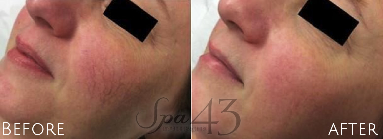 Vascular laser Before and After